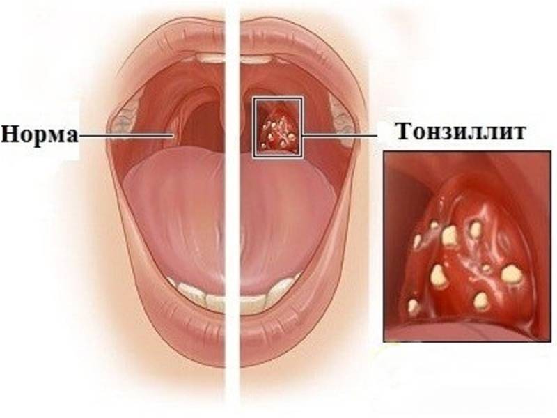 Лечение ангины: антибиотики, полоскание горла, спреи. фото