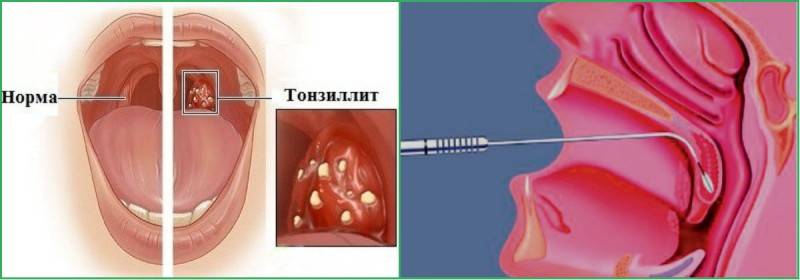 Тонзиллит: симптомы и лечение хронического тонзиллита, как лечить тонзиллит острый у детей и взрослых