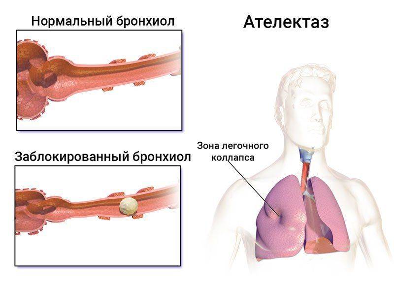 Схема ателектаза при туберкулезе