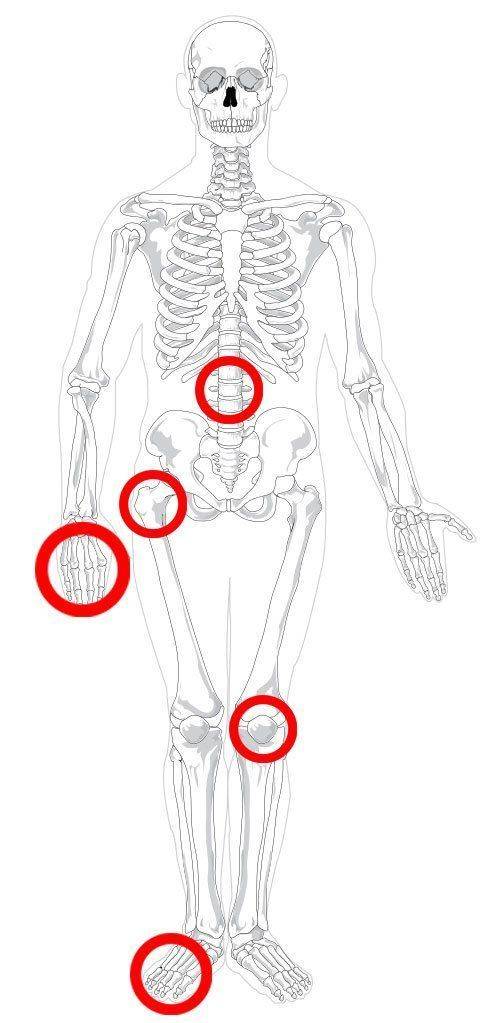 Проявления туберкулеза костей и суставов