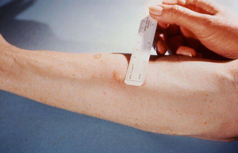 mantoux-tuberculin-skin-test-procedure-and-how-to-read-it-r-n-stuff