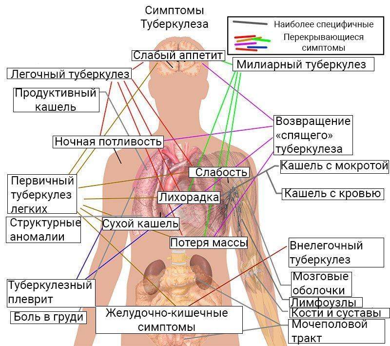 Схема симптомов при туберкулезе