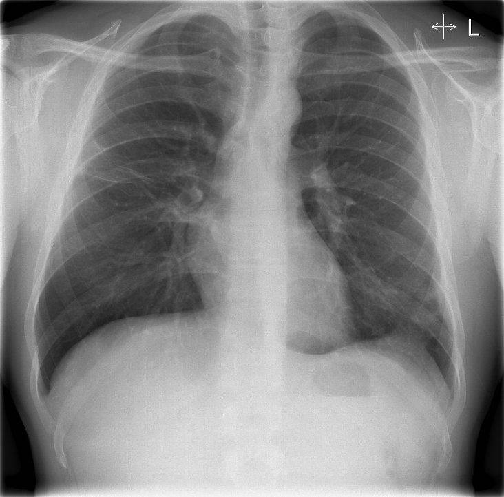 Пневмония на рентгене