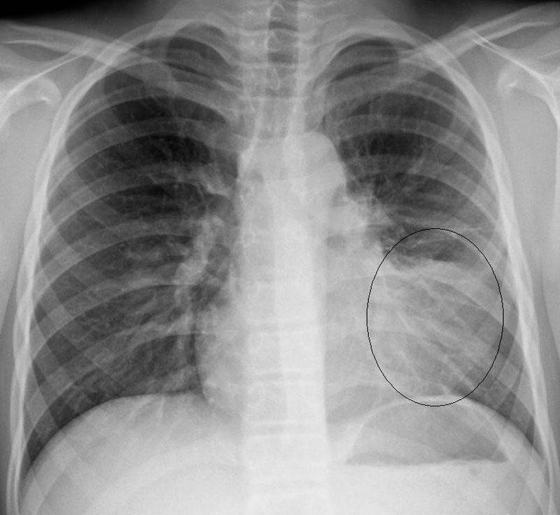 Пневмония на рентгенографии