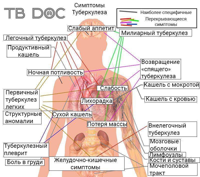 Схема главных симптомов туберкулеза