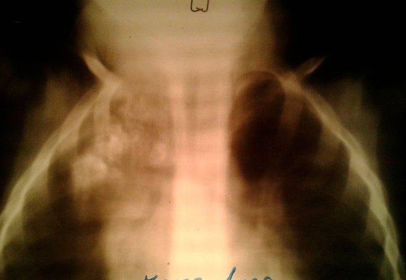 Туберкулома на рентгеновском снимке