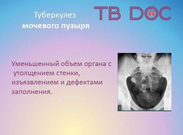 Мочевой пузырь поражен туберкулезом