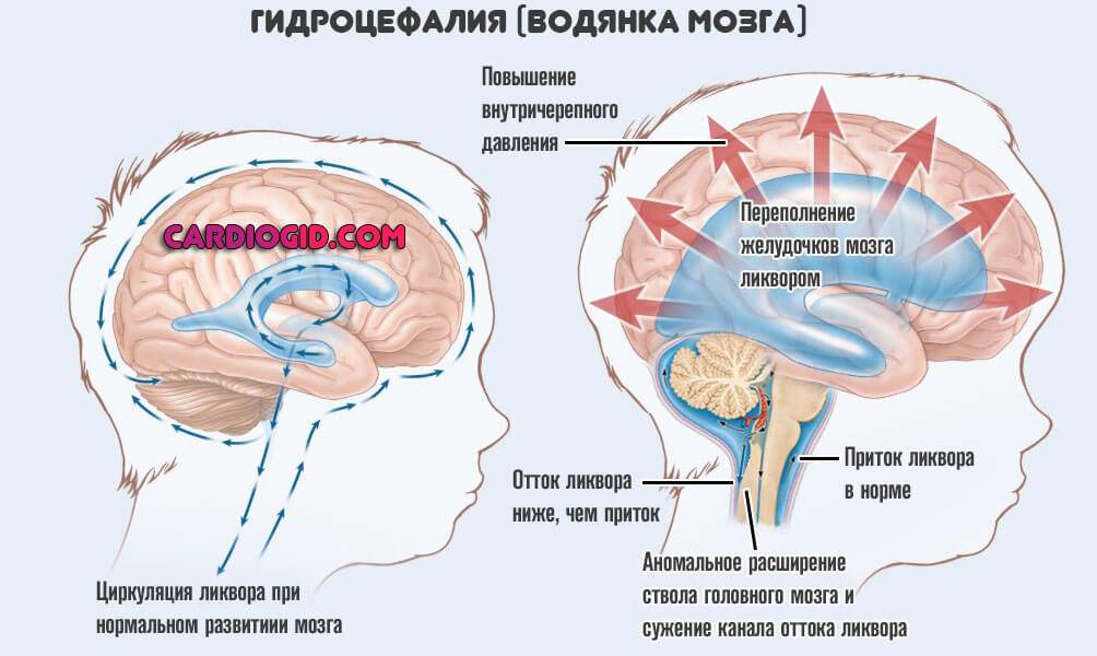Как лечить гидроцефалию головного мозга у взрослых