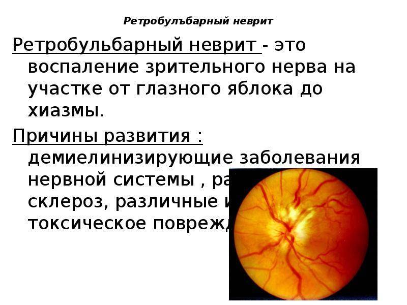 Неврит глазного нерва симптомы