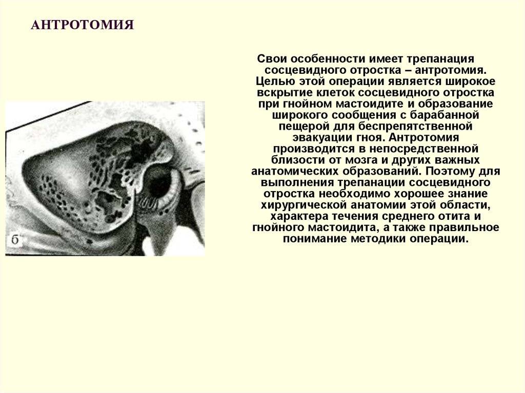 Что такое мастоидит, его характеристика, симптомы и лечение pulmono.ru
что такое мастоидит, его характеристика, симптомы и лечение