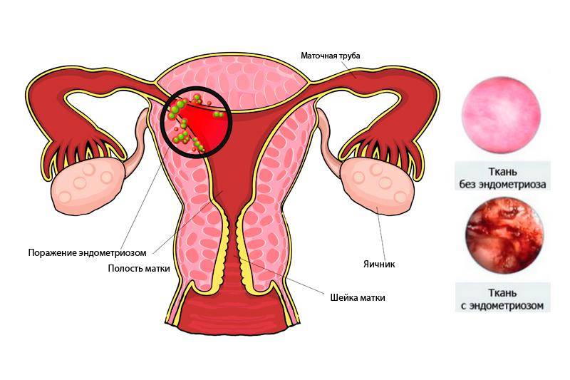 Эндометриоз матки: эффективное лечение народными средствами