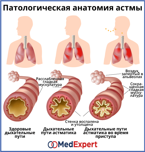 Аллергическая астма симптомы