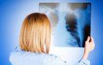 Пневмония — симптомы у взрослых. по каким признакам можно определить воспаление легких в домашних условиях