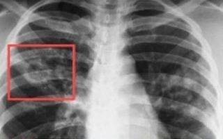 Заразен ли инфильтративный туберкулез легких и чем он опасен