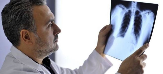 Гастроэзофагеальный рефлюкс: симптомы, лечение и диета