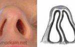Чем опасно искривление перегородки носа, причины, лечение и реабилитация