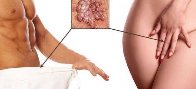 Симптомы и схема лечения впч у мужчин в домашних условиях