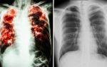 Закрытая форма туберкулеза можно ли заразиться