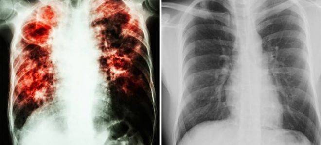 Закрытая форма туберкулеза можно ли заразиться