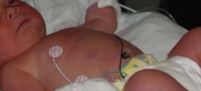 Цитомегаловирус у детей, у женщин при беременности. результаты анализов и обнаружение антител. симптомы и лечение цитомегаловирусной инфекции