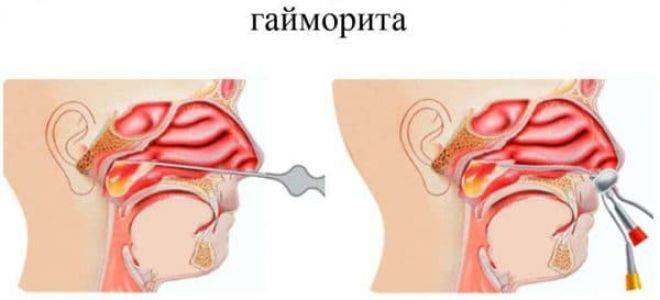 Острый двухсторонний гайморит и хронический