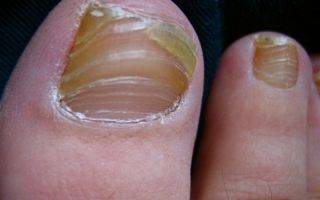 Варианты протезирования ногтей