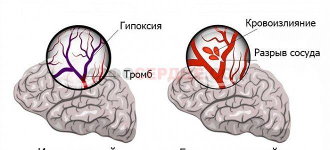 Как не пропустить первые признаки инсульта, предвестники онмк