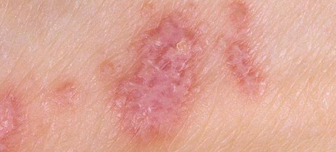 Лишай у человека