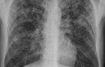 Хроническая форма туберкулеза