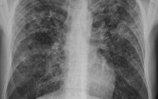 Хроническая форма туберкулеза