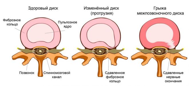 Грыжи диска с секвестрацией