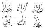 Признаки перелома пальца на ноге