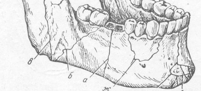 Особенности перелома верхней челюсти: классификация по лефору, диагностика, лечение