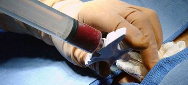 Воспаление плечевого сустава лечение народными средствами