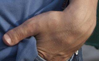 Причины возникновения брахидактилии большого и других пальцев, симптомы, осложнения, методы диагностики и лечения