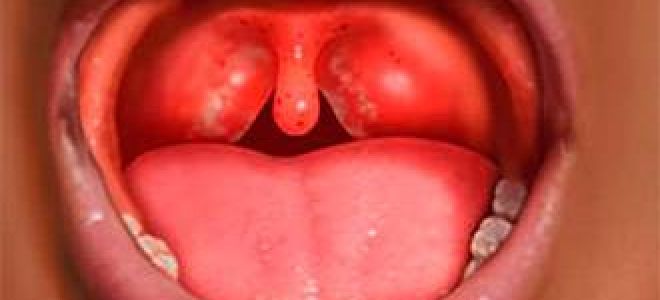 Фарингит у ребенка лечение