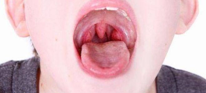 Инфекционный тонзиллит вирусный