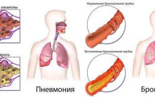 Отличия пневмонии, бронхита и туберкулеза