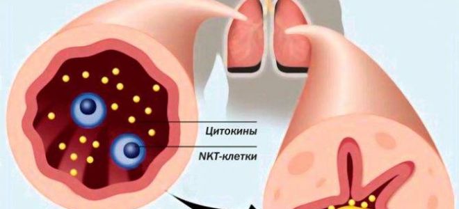 Причины и механизм развития приступа астмы, симптомы, первая помощь, лечение