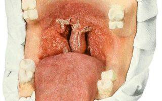 Туберкулез полости рта