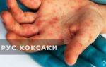 Турецкий вирус коксаки: симптомы у детей. 9 фото