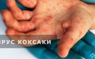 Турецкий вирус коксаки: симптомы у детей. 9 фото