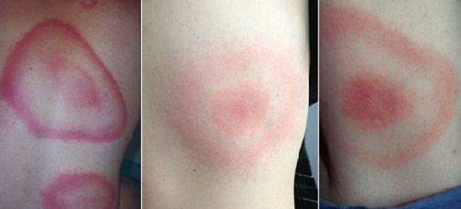 Болезнь лайма (клещевой боррелиоз): симптомы, лечение, фото