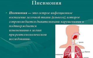 Пневмония: заразна она или нет?