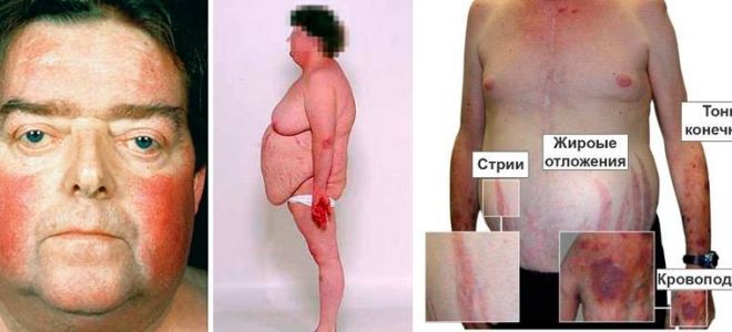 Болезнь иценко-кушинга