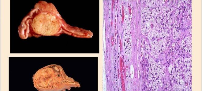 Патологии надпочечников и их лечение народными средствами
