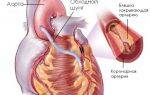 Аортокоронарное шунтирование сосудов сердца