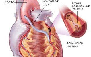 Аортокоронарное шунтирование сосудов сердца