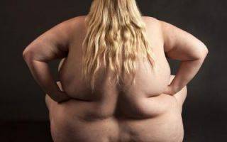 Абдоминальное ожирение: у мужчин и женщин, способы лечения патологии