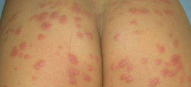 Многоформная экссудативная эритема